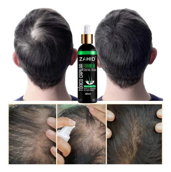 Shampoo Zahid Minoxidil Forte y Tónico Capilar - Imagen 7